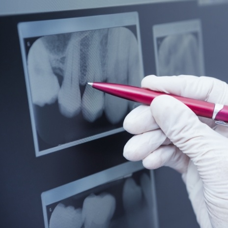 Dentist pointing to an x ray of teeth