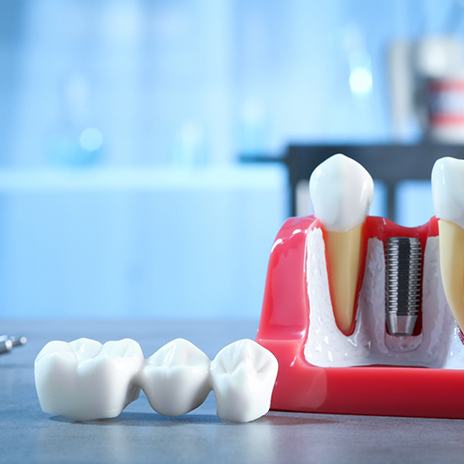 Dental bridge and crown on table next to large model dental implant
