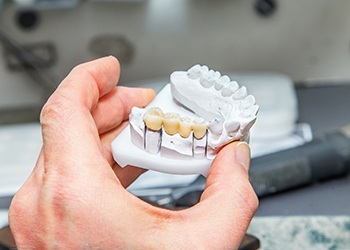Hand holding cast of lower arch with dental bridge spanning 4 teeth
