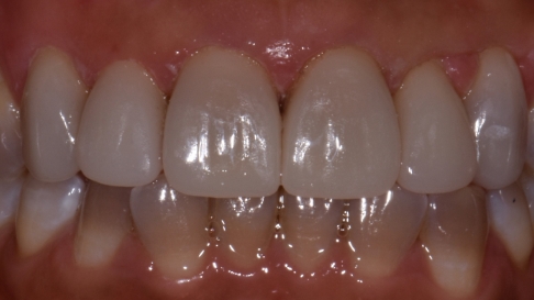 Close up of flawless teeth after dental treatment