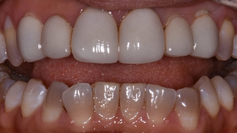 Close up of imperfect teeth before treatment from Alpharetta dentist