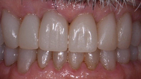 Close up of brighter teeth