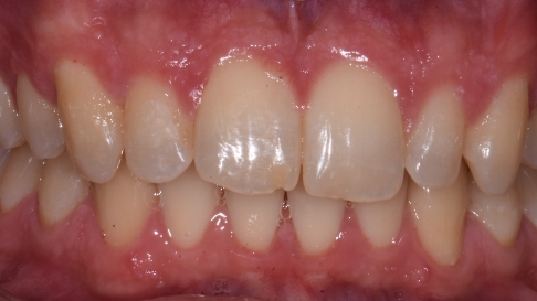 Close up of restored teeth