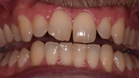 Close up of damaged teeth