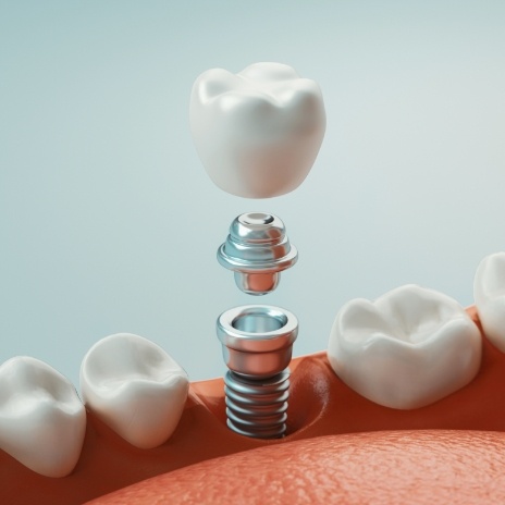 Illustrated dental implant in Alpharetta replacing a missing tooth