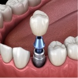 Illustrated dental crown being placed onto a dental implant