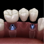 Illustrated dental bridge being placed onto two dental implants