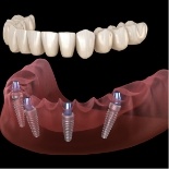 Illustrated denture being placed onto four dental implants