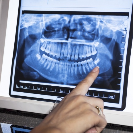 Dentist pointing to digital x rays of teeth