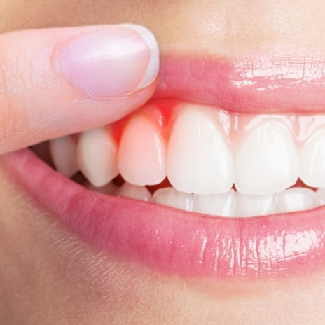 Close up of person pointing to their red gums before gum disease treatment