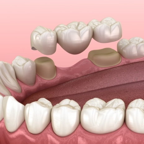 Illustrated dental bridge replacing a missing tooth