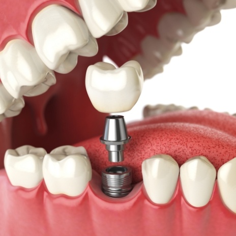 Illustrated dental implant with crown replacing a missing tooth