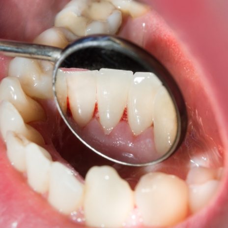 Close up of dental mirror inside of mouth