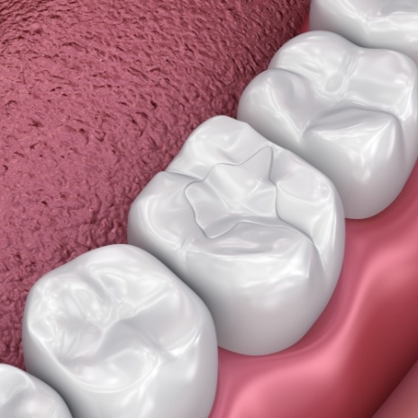 Illustrated row of teeth with dental sealants