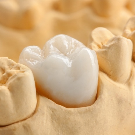 Dental crown over a tooth in a model of the mouth