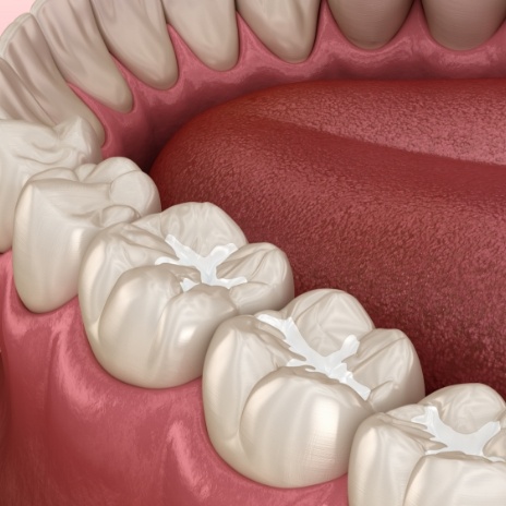 Illustrated row of teeth with white fillings