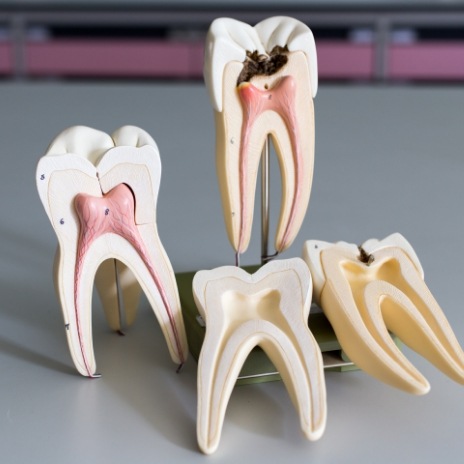 Models of damaged teeth needing root canal treatment