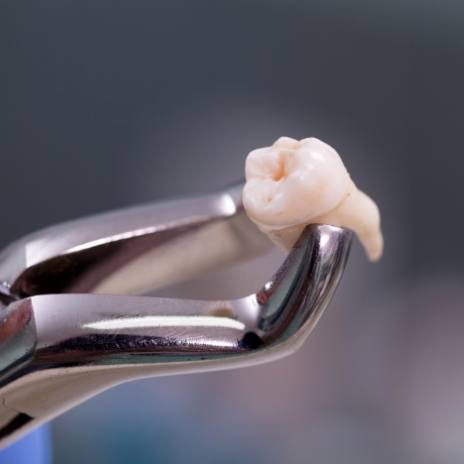 Dental forceps holding an extracted tooth