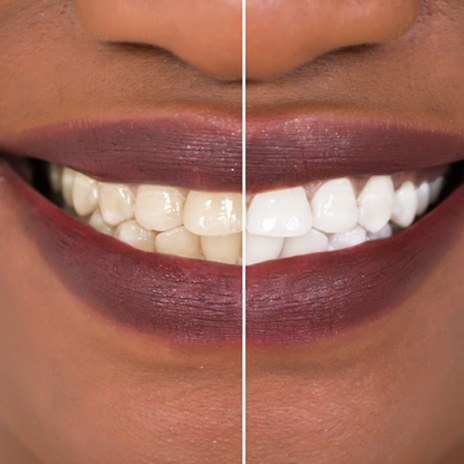 Closeup of patient's smile before and after teeth whitening