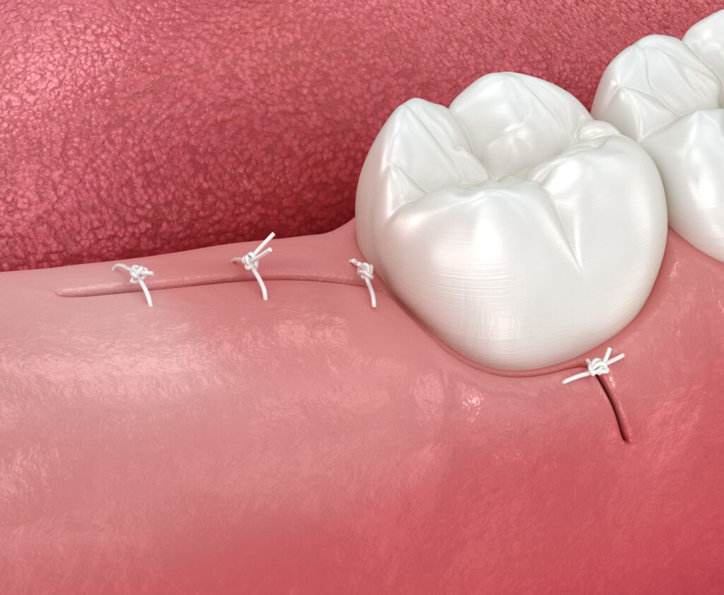 Illustration of stitches closing gums around molar