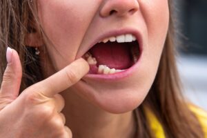 Woman with a back premolar tooth missing