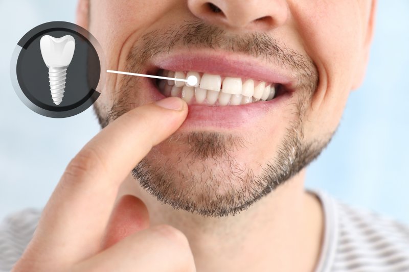 a man pointing at his dental implant