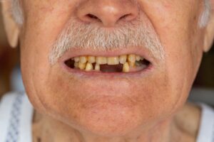 Older man missing multiple consecutive bottom front teeth.